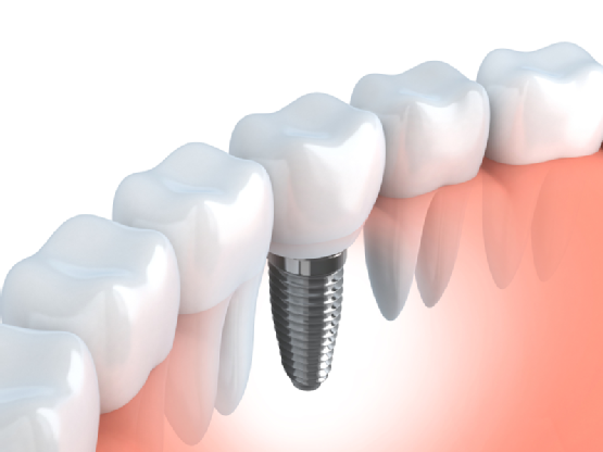 dental implants cleveland