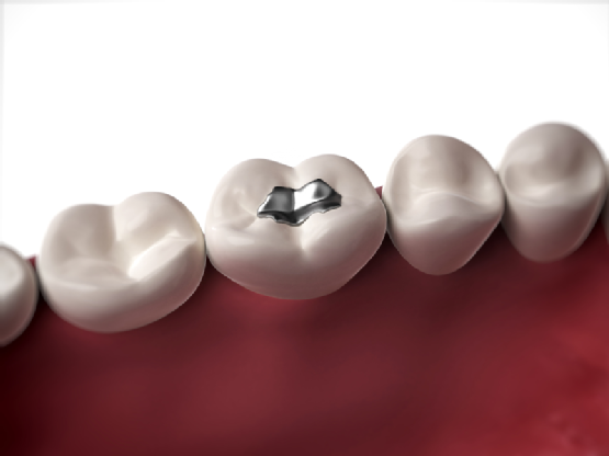 Types of Dental Fillings