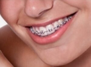 braces