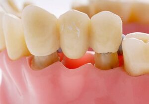 dental-restoration