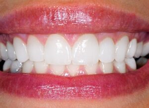 whitening-1(4)